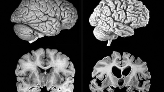 Алцхаймер може да е заразен - при изключително редки обстоятелства